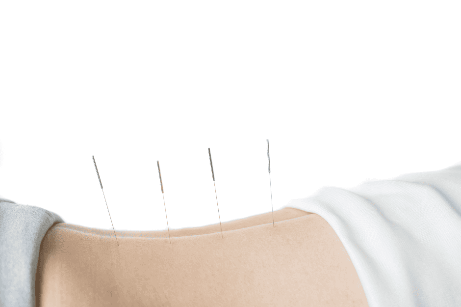 What To Expect At Your First Acupuncture Session – A Step-By-Step Guide including 3 Helpful Tips to Prepare For It