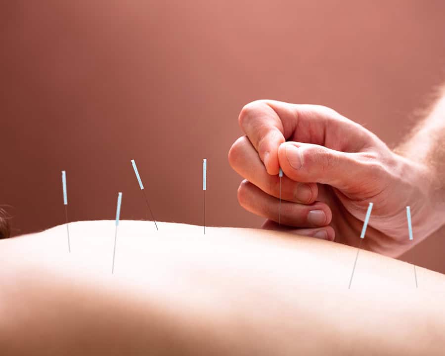 acupuncture needles being inserted into the skin
