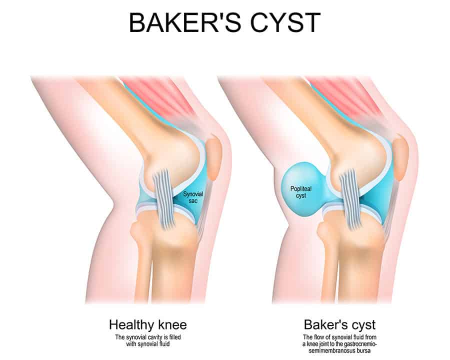 Baker's cyst. Normal knee, and joint with Popliteal cyst